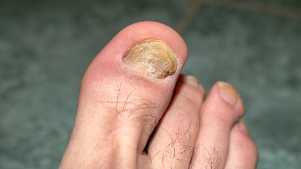 grzybica paznokcia